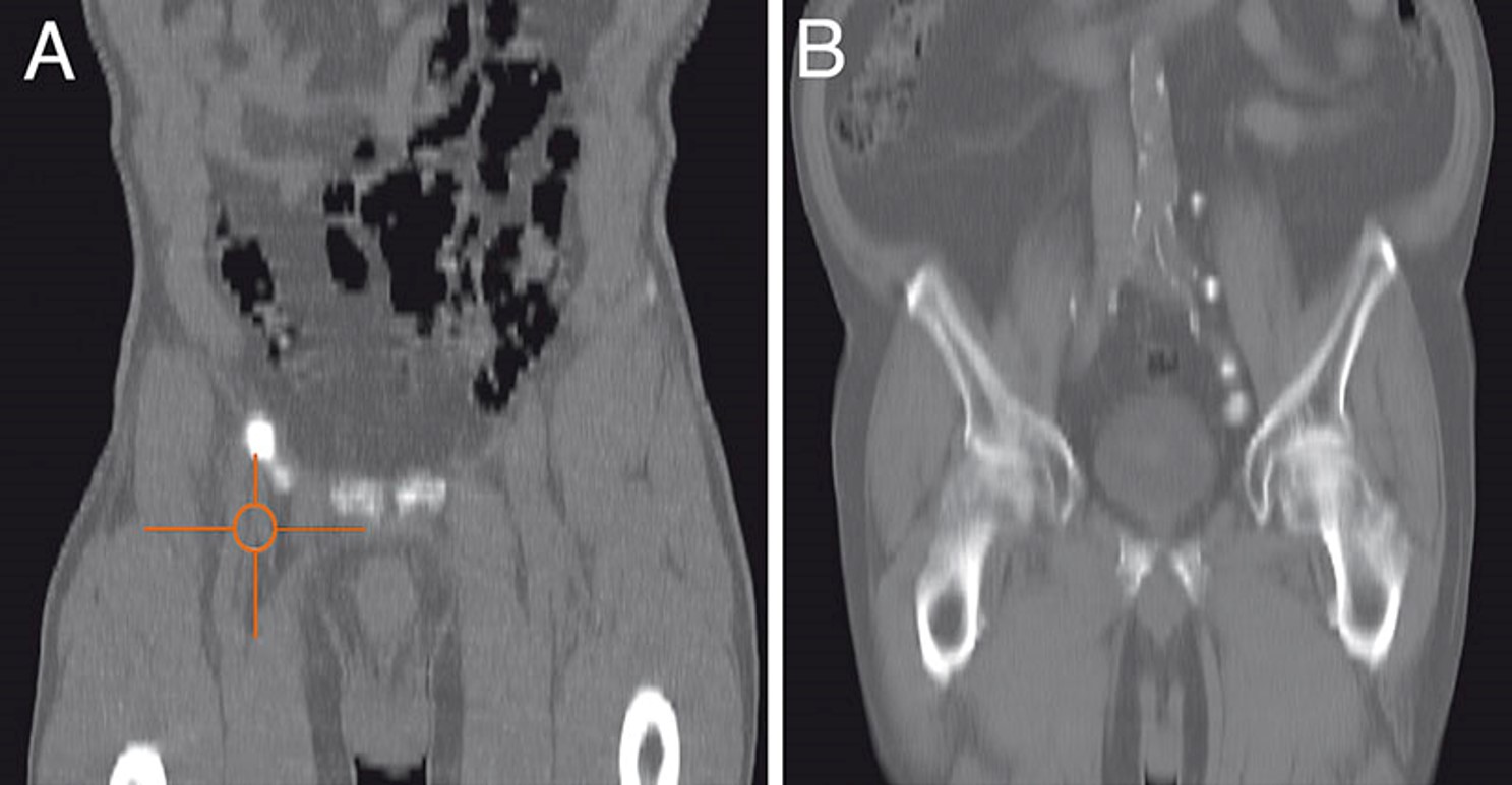 βουβωνική λεμφαδένες σε καρκίνο πέους