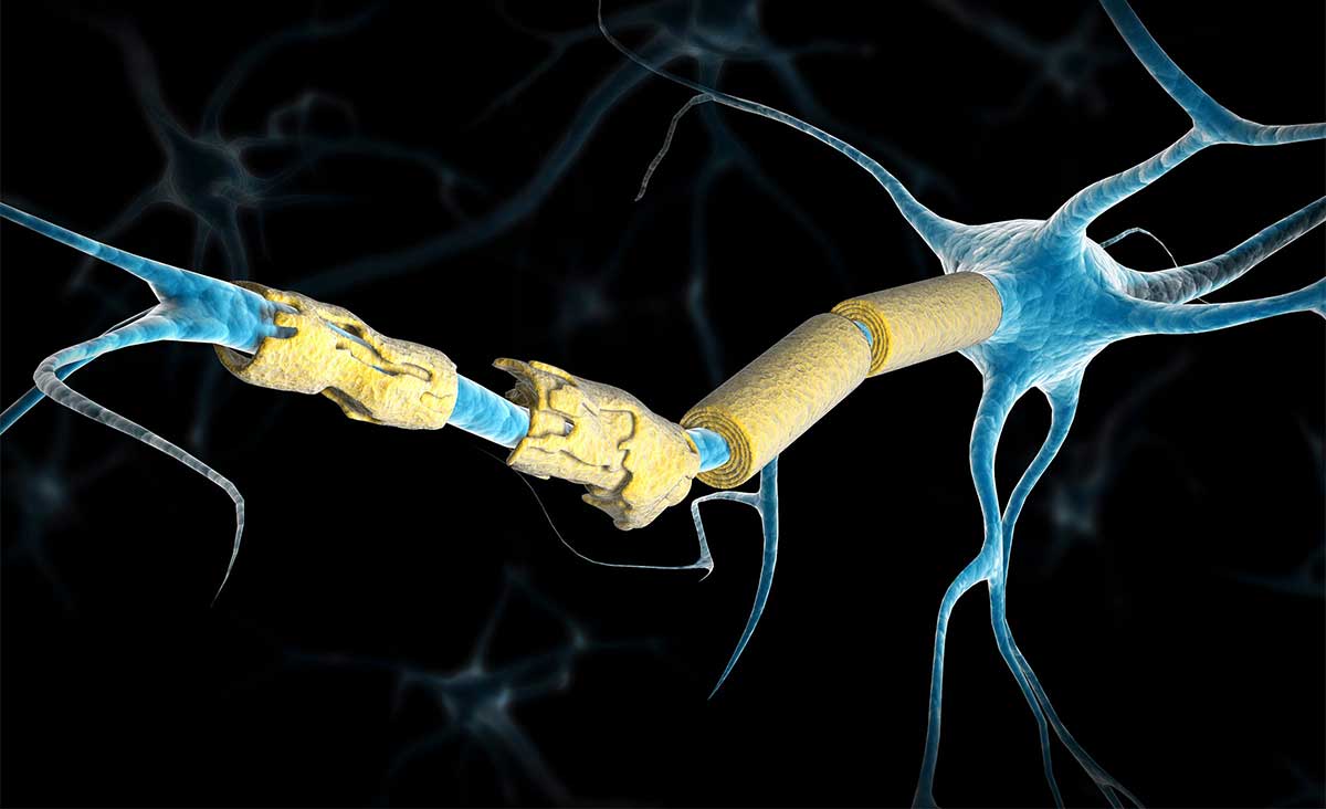 σκλήρυνση κατά πλάκας