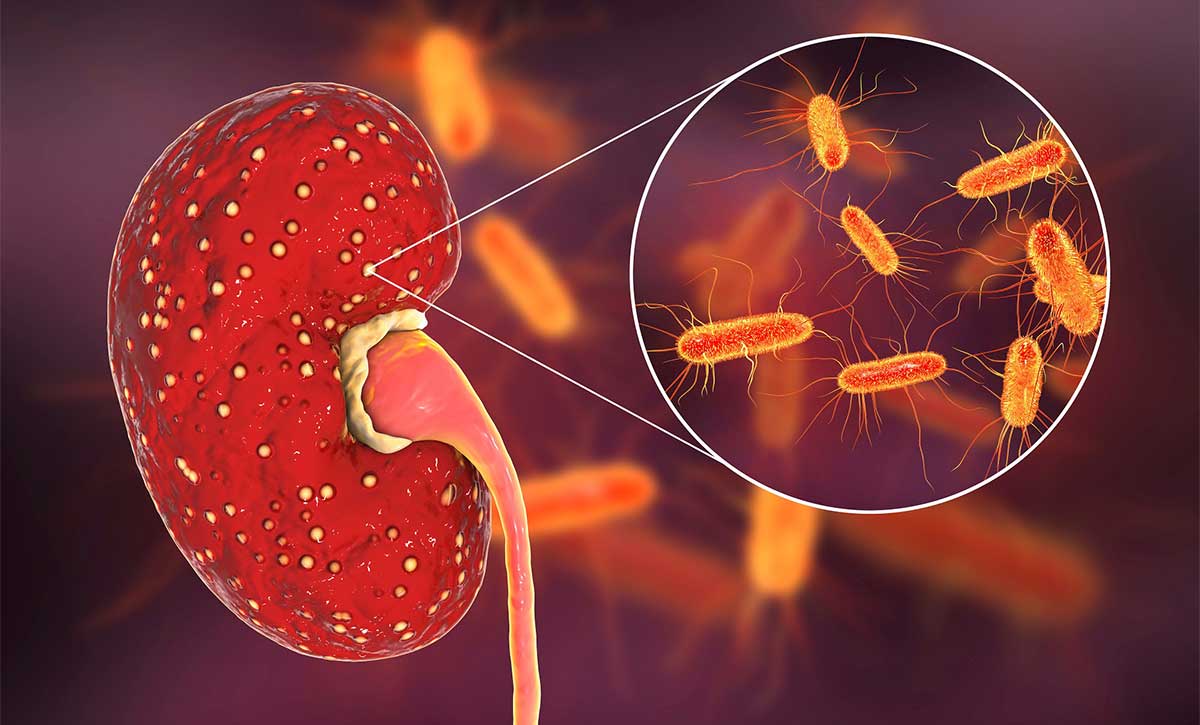 Πυελονεφρίτιδα