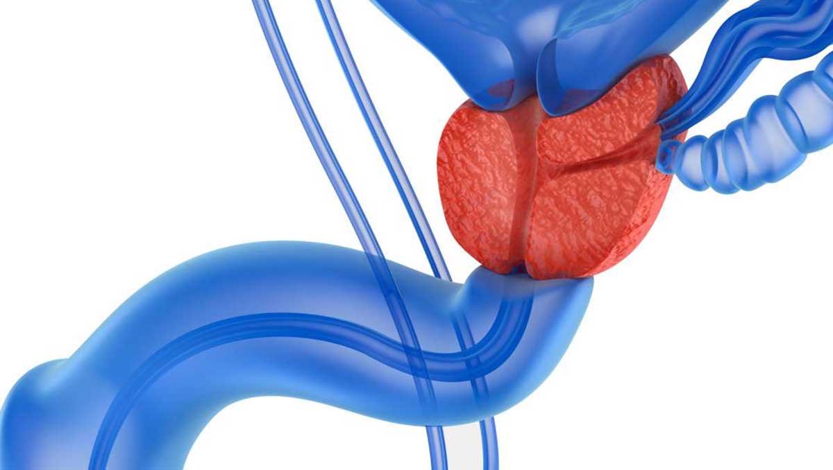 προστατίτιδα